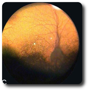 fundus3