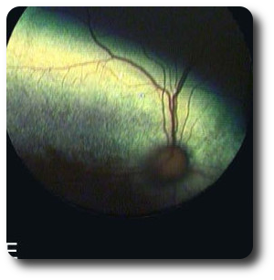 fundus5