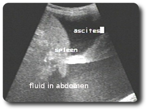 ascites2