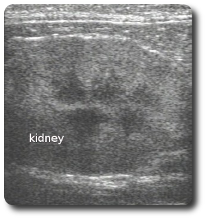 kidney2